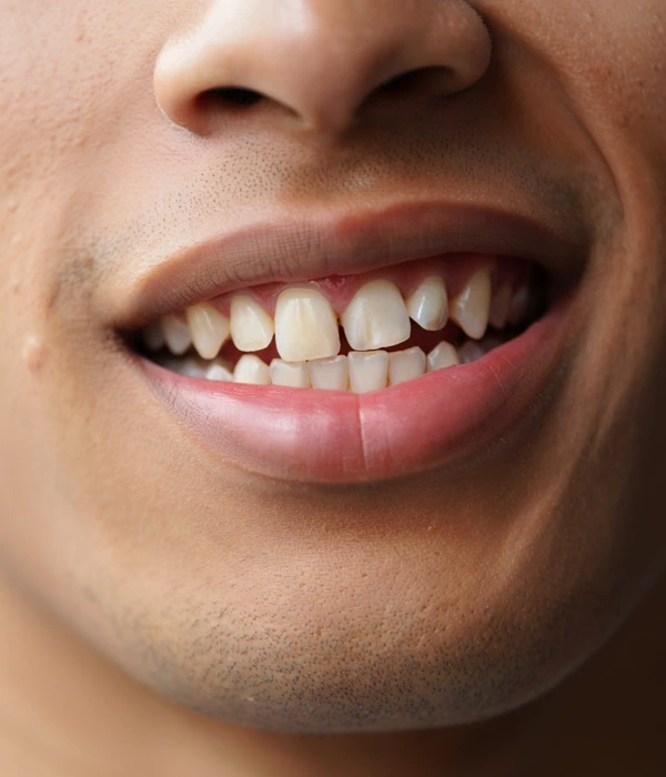 When do you need dental bonding