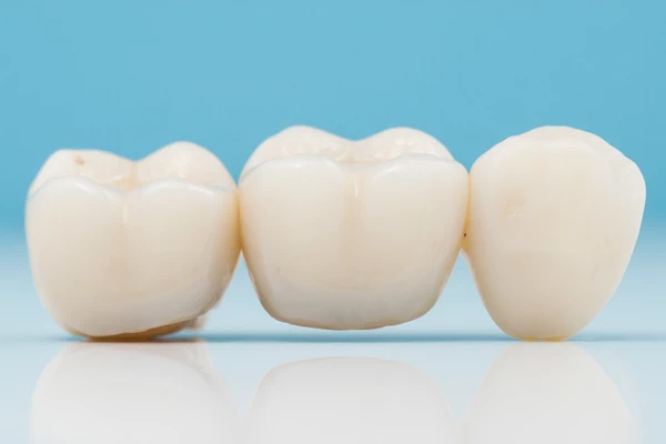 Traditional Dental Bridge