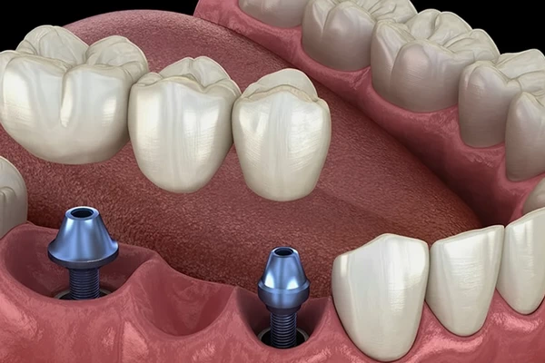 Implant-Supported
